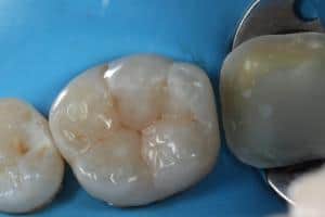 Nová výplň podle principů biomimetic dentistry