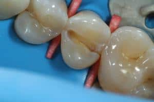 Zjištěna fraktura kořene, jediná možná léčba je extrakce a imediální implantace.