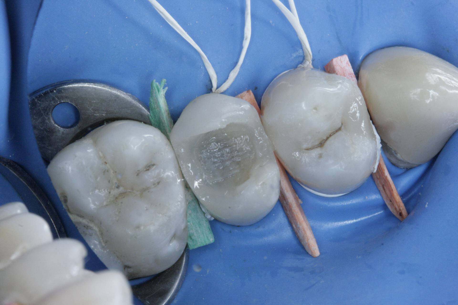 Kittler Dent – Jak probíhá biomimetické ošetření